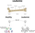 Leukemia Bone