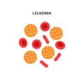 Leukemia cancer disease Royalty Free Stock Photo