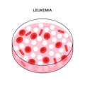 Leukemia cancer disease Royalty Free Stock Photo