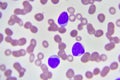 Leukemia cells Royalty Free Stock Photo