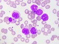 Leukemia cells