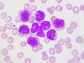 Leukemia cells