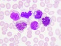 Leukemia cells in blood smear Royalty Free Stock Photo