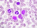 Leukemia cells in blood smear Royalty Free Stock Photo