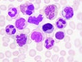 Leukemia cells in blood smear Royalty Free Stock Photo