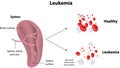 Leukemia