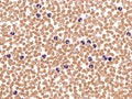 Leukemoid reaction in peripheral blood.