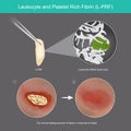 Leukocyte and Platelet Rich Fibrin. Illustration wound healing process of skin tissue by use Leukocyte from platelet rich fibrin