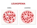 Leukopenia, leukocytopenia or leucopenia Royalty Free Stock Photo