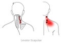 Levator scapulae myofascial trigger point rear upper neck pain Royalty Free Stock Photo