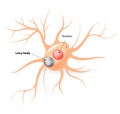 Lewy body. Parkinsons disease and Alzheimers disease