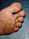 The lid of a person`s foot is broken and is dirty.