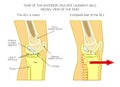 Ligaments of the knee_Torn anterior cruciate ligament Royalty Free Stock Photo