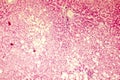 Light micrograph of a fatty liver Royalty Free Stock Photo