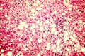 Light micrograph of a fatty liver Royalty Free Stock Photo