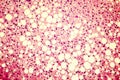 Light micrograph of a fatty liver Royalty Free Stock Photo