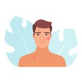 Man with acne and pimple problems Royalty Free Stock Photo