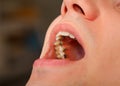Lingual braces Royalty Free Stock Photo