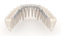 Lingual braces system. 3D illustration concept of silver braces