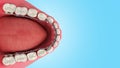 Lingual braces system on a demonstration denture 3d on blue gradient Royalty Free Stock Photo