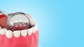 Lingual braces system on a demonstration denture 3d close up on blue gradient Royalty Free Stock Photo