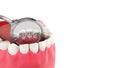 Lingual braces system on a demonstration denture 3d close up on white