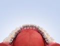 Lingual braces system on a demonstration denture 3d on color gradient