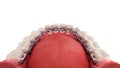 Lingual braces system on a demonstration denture 3d on white