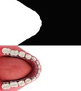 Lingual braces system on a demonstration denture 3d on wnite Alpha include Royalty Free Stock Photo