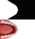 Lingual braces system on a demonstration denture 3d on wnite Alpha include