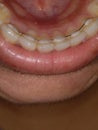 Lingual retainers after orthodontic treatment