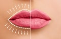 Lip augmentation concept. Woman lips before and after lip filler injections Royalty Free Stock Photo