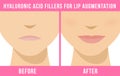 Lip augmentation effects