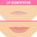 Lip augmentation effects