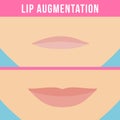 Lip augmentation effects