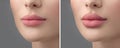 Before and after lip filler injections. Fillers. Lip augmentation Beautiful Perfect Lips. Sexy Mouth close-up. Beauty young woman