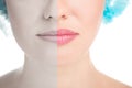 Before and after lip filler injections Royalty Free Stock Photo