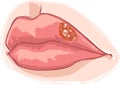Lip herpes