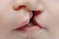 Lip and palate cleft Royalty Free Stock Photo