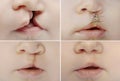 Lip and palate cleft before and after surgery Royalty Free Stock Photo