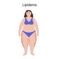 Lipedema fat zones