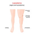 Lipoedema or Lipedema