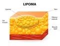 Lipoma