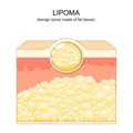 Lipoma. adipose tumors. Skin layers Royalty Free Stock Photo