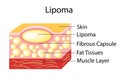 Lipoma are adipose tumors located in the subcutaneous tissues.