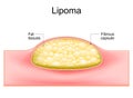 Lipoma. Cross section of a human skin