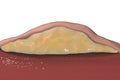 Lipoma, cross-section view Royalty Free Stock Photo