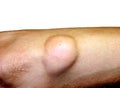 Lipoma on the elbow of the arm Royalty Free Stock Photo