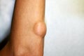 Lipoma on the elbow of the arm Royalty Free Stock Photo