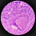 Lipoma on loin, benign growth of fatty tissue, benign neoplasm, adipocytes, partially capsulated tumor,